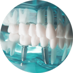 Dental Implant 1
